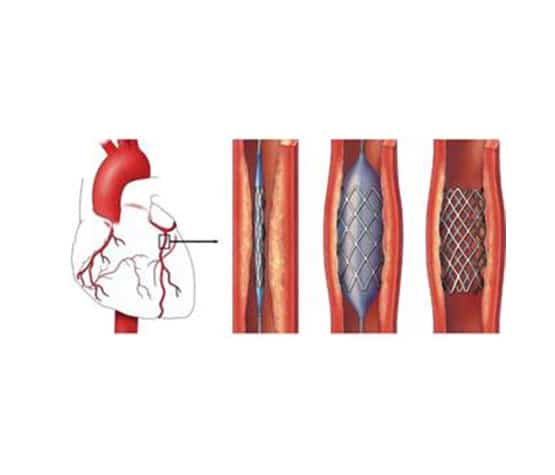 Слика 2: Стентови од нитинола који се сами шире и заузимају задати облик користе се у хируршком лечењу срчаних и обољења крвних судова