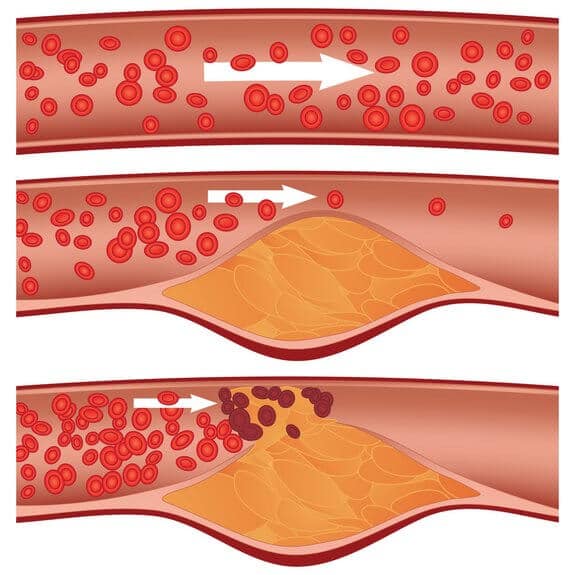 Слика 1. Зачепљење крвног суда проузроковано холестеролом